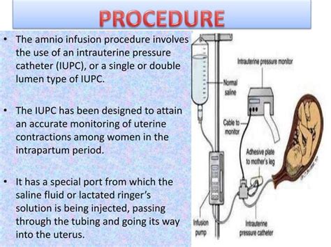 Amnioinfusion