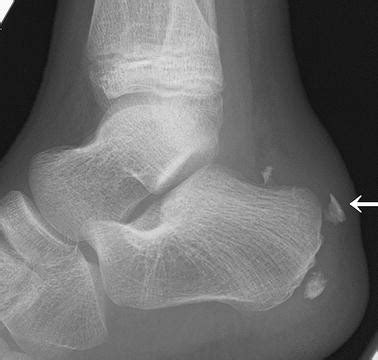 Calcaneal apophyseal avulsion fracture | SpringerLink