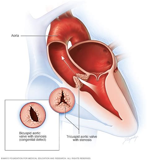 Aortic valve disease - Symptoms and causes - Mayo Clinic