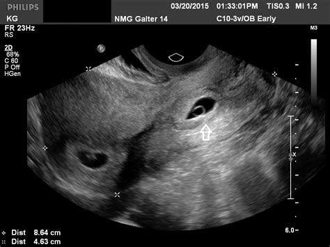 9 Week Ectopic Pregnancy Ultrasound