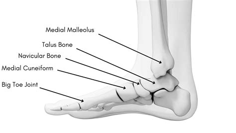 Medial Malleolus Fracture | Medial Malleolus Avulsion Fracture