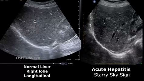 Liver Ultrasound Normal Vs Abnormal Image Appearances Comparison | Free ...