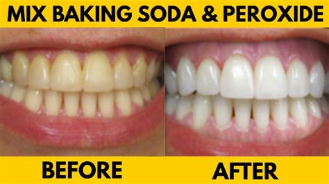 Baking soda and Hydrogen Peroxide teeth whitening - #1 DENTIST IN ...