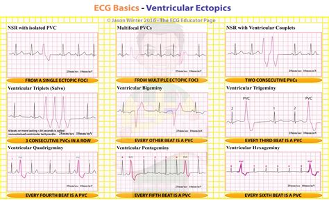 ECG Educator Blog : Ventricular Ectopics