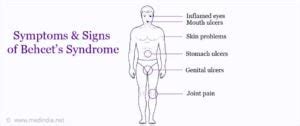 Behcet’s Disease - Its Symptoms, Causes And Types