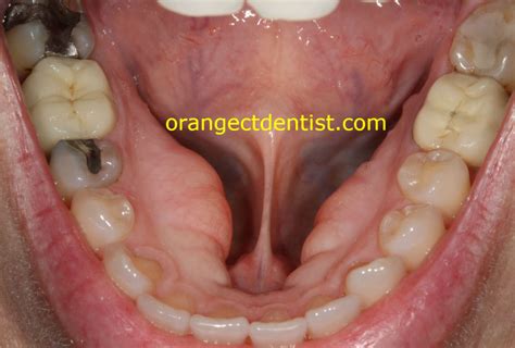 Dental Tori or Torus | Torus Palatinus | Torus Mandibularis