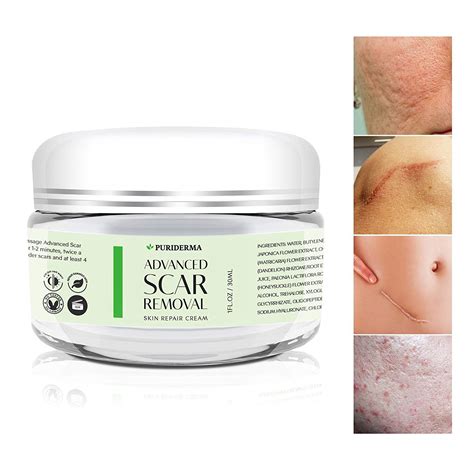 Scar Removal Cream – Advanced Treatment for Face & Body, Old & New ...