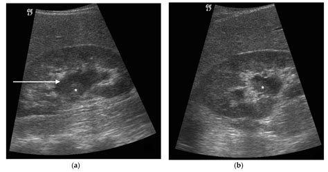 Pyonephrosis Ultrasound