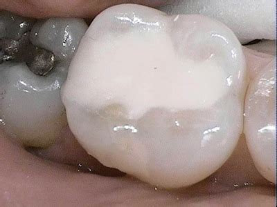 Incorporating Glass Ionomers into Everyday Dental Practice