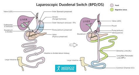 Duodenal Switch Surgery – The Procedure - Mexico Duodenal Switch