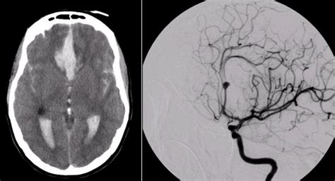 Cerebral Aneurysm Angiogram