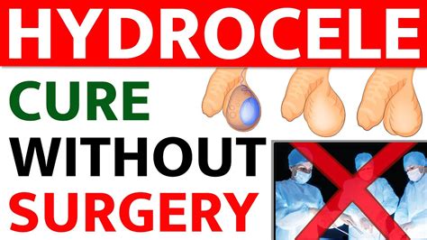 Hydrocele Cure Without Surgery || Hydrocele Causes, Symptoms, and ...