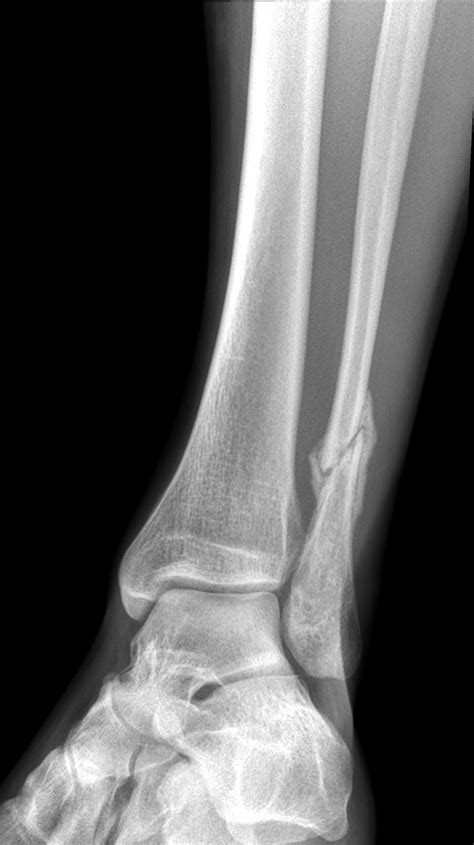 Fibula fracture - ebnipod