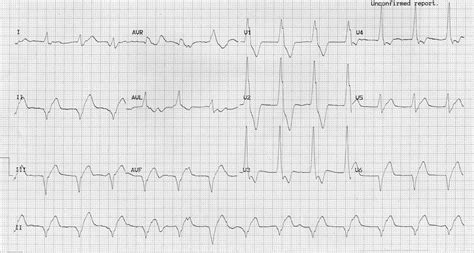 Accelerated Idioventricular Rhythm (AIVR) • LITFL • ECG Library