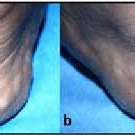 (PDF) Pain in heels: Two cases with piezogenic pedal papules