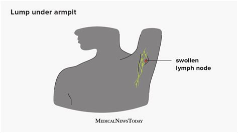 Swollen lymph nodes in armpit: Symptoms, causes, and treatment (2022)