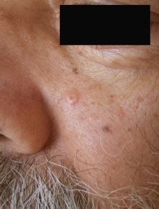 👉 Sebaceous Hyperplasia - Pictures, Removal, Symptoms, Treatment ...