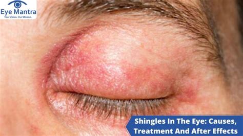 Shingles In The Eye: Causes, Treatment And After Effects