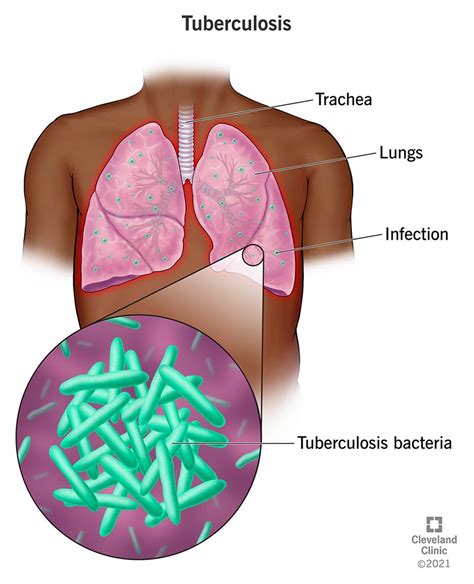 Tuberculosis: Causes, Symptoms, Diagnosis & Treatment