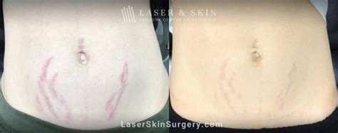 Laser Stretch Mark Removal in New York