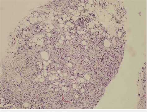 Patient #1: Tru-cut biopsy of the supraclavicular lymph node. Tumor ...