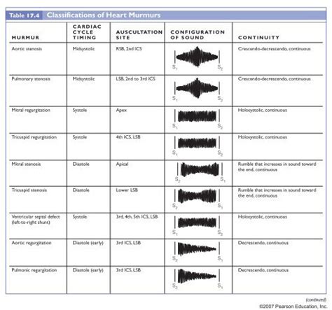 Classifications of Heart Murmurs - Pearson