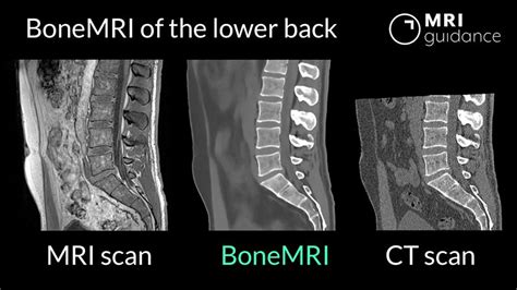 BoneMRI now available for lower back - MRIguidance