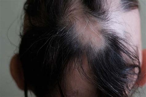 3 signs of regrowth in alopecia areata - Lady Alopecia