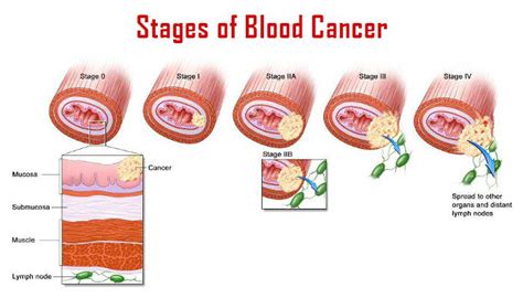 Blood Cancer Types