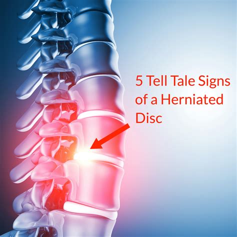 5 Tell Tale Signs of a Herniated Disc (Slipped Disc) - Fornham ...