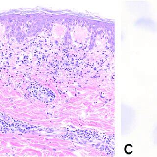 Patient 2. A, Clinical image of lichenoid dermatitis on the left side ...