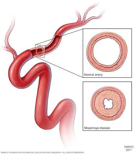 Moyamoya disease - Symptoms and causes - Mayo Clinic