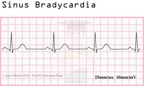 ECG Educator Blog : Sinoatrial Node rhythms