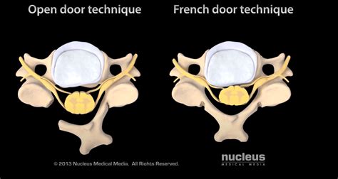 Cervical Laminoplasty: Definition - Spine Info