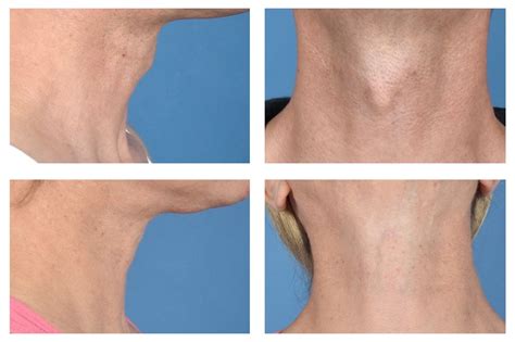 UCLA surgeons develop new technique to reduce Adam’s apple without neck ...