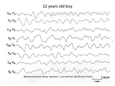 Abnormal EEG patterns