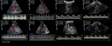 Transcranial Doppler – Sonographic Tendencies | Vascular ultrasound ...