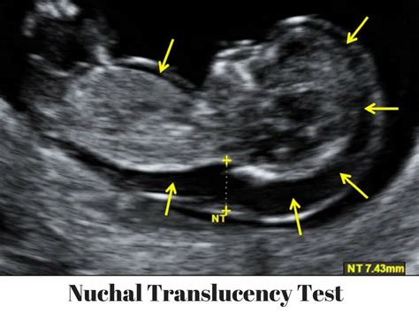 Nuchal Translucency Teat (NT Scan) Procedure To Detect Down Syndrome