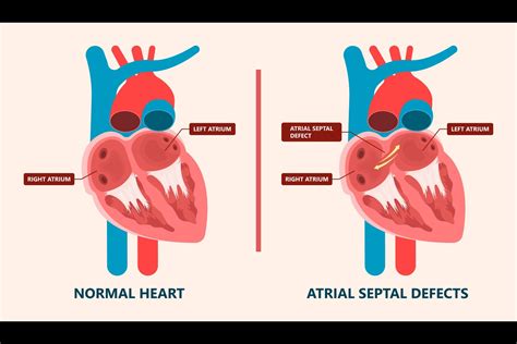 Atrial Septal Defect: Symptoms, Causes & Treatments | Meril Life