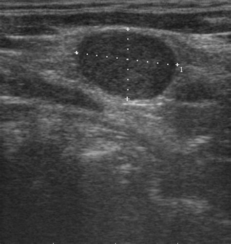 Abnormal Neck Ultrasound