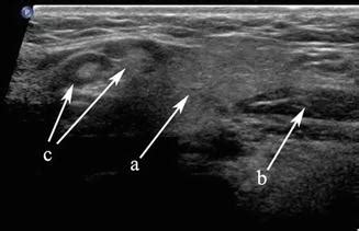 Submandibular Lymph Nodes