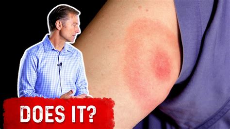 Does the Bullseye Rash Mean Lyme Disease? - YouTube