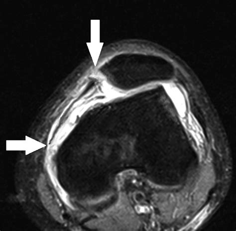 22-year-old woman was diagnosed with combined MPFL injury (complete ...