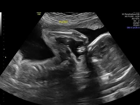 【ベストコレクション】 24 weeks pregnant ultrasound gender 220010-24 weeks ...