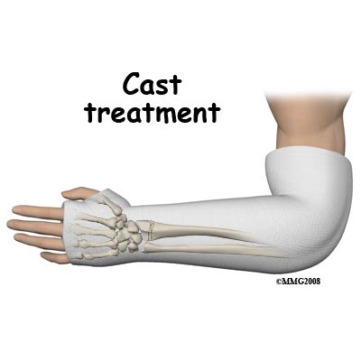 Physical Therapy in our clinic for Wrist Pain - Fractures