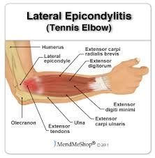 Lateral Epicondylitis | ProActive Physical Therapy