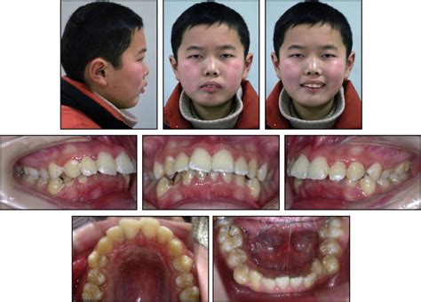 Two-phase treatment of skeletal Class II malocclusion with the ...