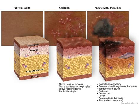 Medmovie.com | Necrotizing Fasciitis