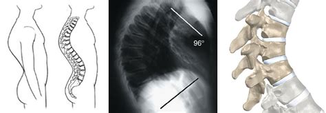 Scheuermann’s Disease - SpinePlus