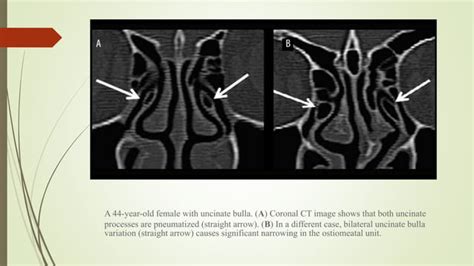 Surgical anatomy of osteomeatal complex | PPT